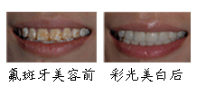 郑州唯美氟斑牙案例