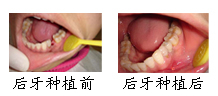 郑州唯美后种植牙牙齿种植成功案例