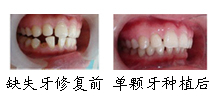郑州唯美单颗牙齿缺失治疗前后对比
