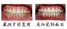 郑州唯美瓷贴面案例