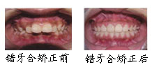 郑州唯美成人牙齿矫正案例