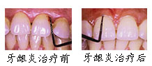 郑州唯美牙龈炎案例