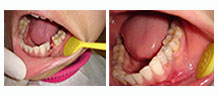 后种植牙牙齿种植成功案例