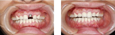 种植牙修复后牙成功案例