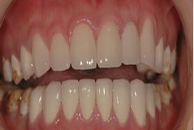 常见的氟斑牙种类都有哪些