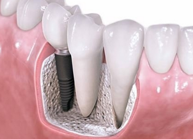 种植牙与传统假牙相比有哪些优点