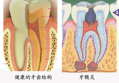 急性牙髓炎不治疗会自己好吗