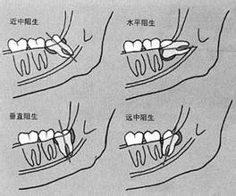 郑州拔智齿去哪个医院好