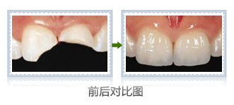 郑州补牙大概多少钱