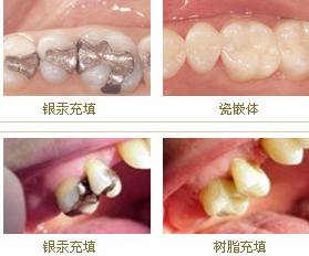 为什么有时补牙不能一次完成