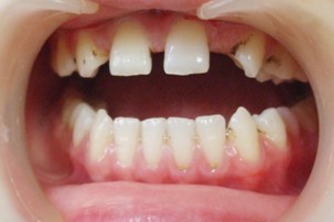 牙齿稀疏用哪种矫正方法好