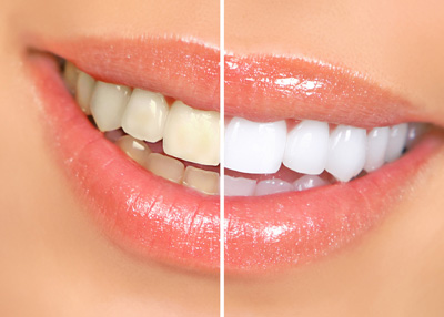 氟斑牙可以变白吗