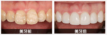 　烤瓷牙的种类及价格全面介绍