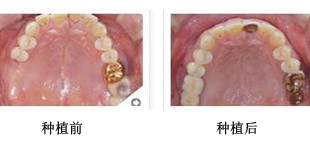 种植牙在什么时候可以做