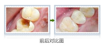 补牙容易掉吗