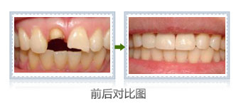 郑州补牙哪家好点