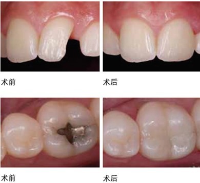 小儿蛀牙怎么办