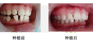 种牙齿是怎么回事