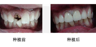 　种牙和镶牙的区别
