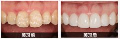 二氧化锆全瓷牙修复牙齿