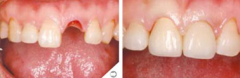 种植牙的危害有哪些？如何选择有保障的种植牙？